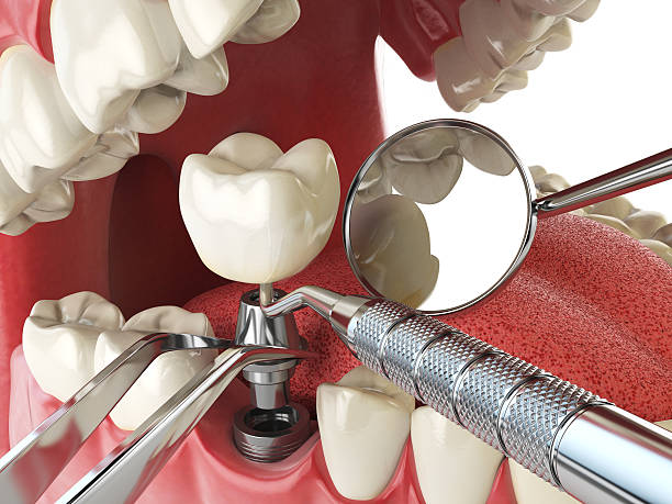 Best Emergency Denture Repair in Columbia, SC
