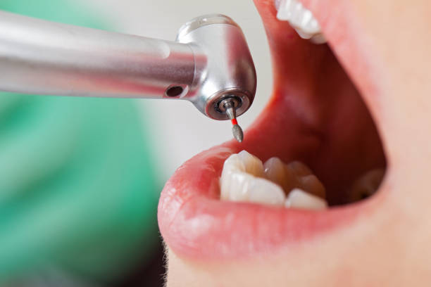 Best Knocked-Out Tooth (Avulsed Tooth) Treatment in Columbia, SC